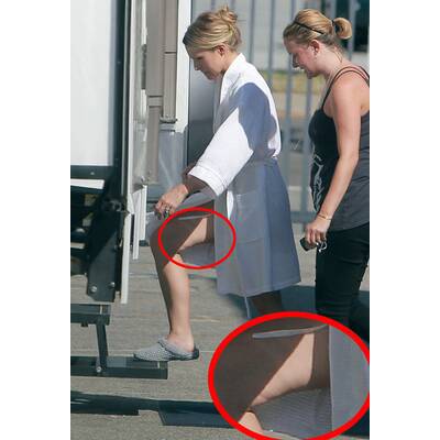 Dellen-Alarm bei den Promis