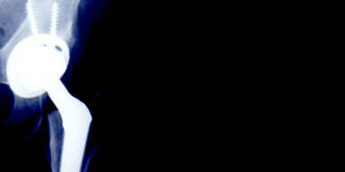 061001_hueftgelenk