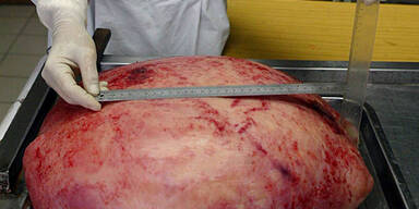 061025_nachsiebentagenl&ouml;schen_Tumor_Arzt_EPA