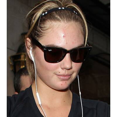 Kate Upton ungeschminkt: Hautprobleme