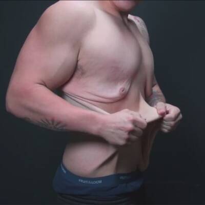 Haut nach 70 Kilo Gewichtsverlust