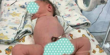 Baby mit 3 Beinen und 2 Penissen geboren