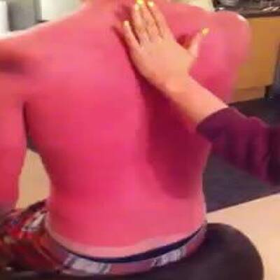 Die schlimmsten Sonnenbrände der Welt