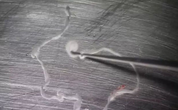 Chinese hatte 15 Jahre lang Bandwurm im Gehirn