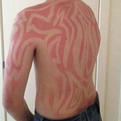 Die schlimmsten Sonnenbrände der Welt