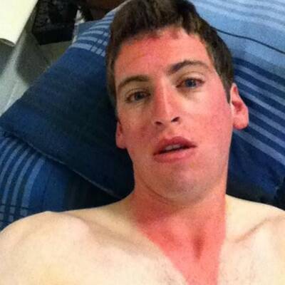 Die schlimmsten Sonnenbrände der Welt