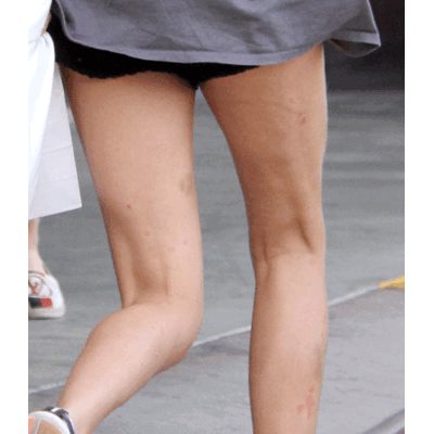 Cara Delevingne kämpt mit Hautproblemen