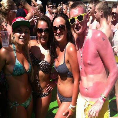 Die schlimmsten Sonnenbrände der Welt