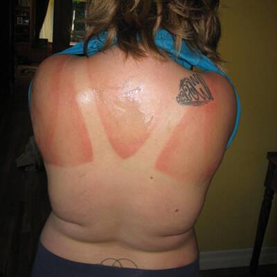 Die schlimmsten Sonnenbrände der Welt