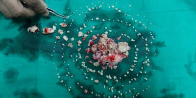 Teenie (17) bekam 232 Z&auml;hne gezogen