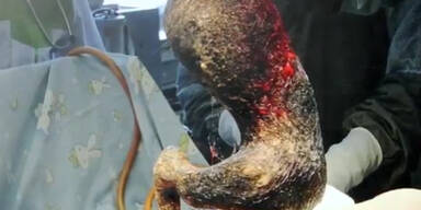 M&auml;dchen hat 4kg Haare im Magen