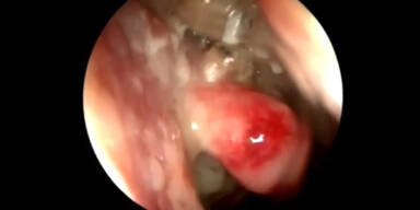 Mann hat 50 Maden in der Nase