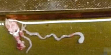 8 cm langer Wurm im Kopf