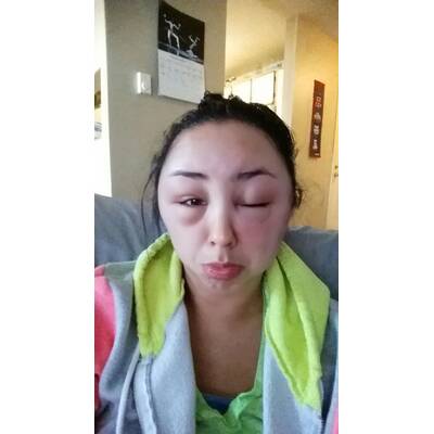 Allergische Reaktion nach Haarefärben. 