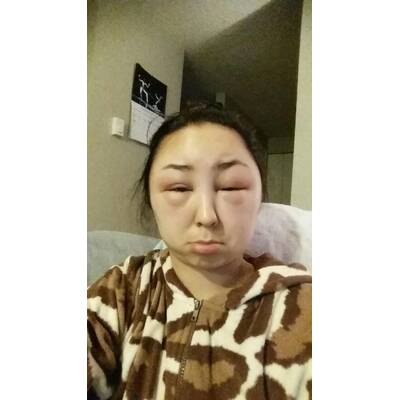 Allergische Reaktion nach Haarefärben. 