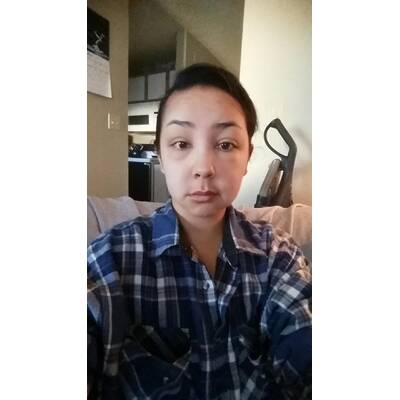 Allergische Reaktion nach Haarefärben. 