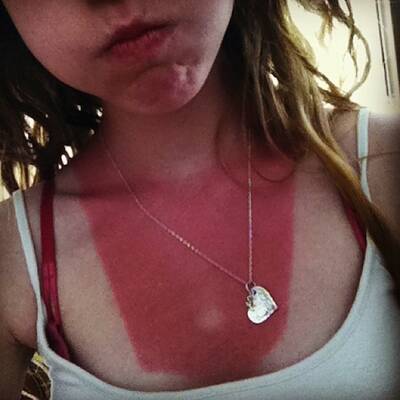 Die schlimmsten Sonnenbrände der Welt