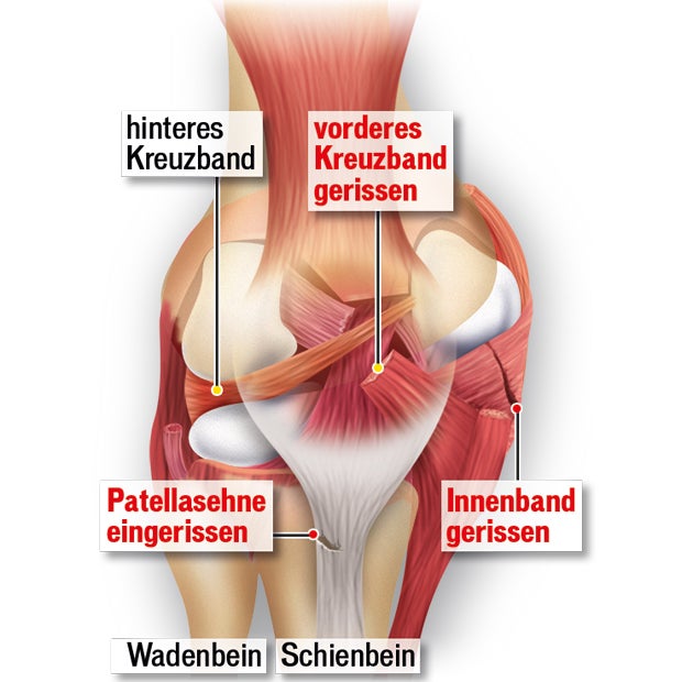 Fenninger: Schock-Diagnose Kreuzbandriss