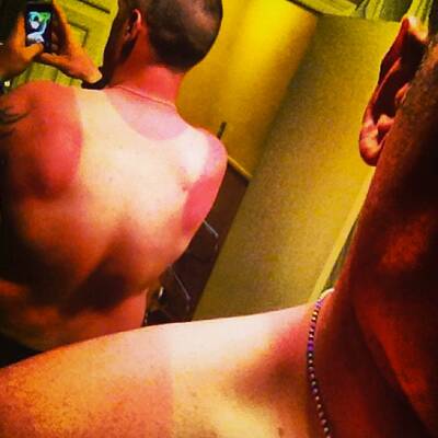 Die schlimmsten Sonnenbrände der Welt