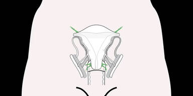 Erste Gebärmutter-Transplantation