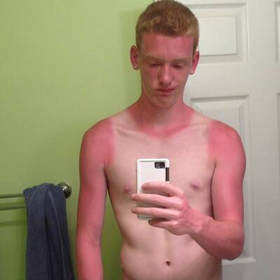 Die schlimmsten Sonnenbrände der Welt