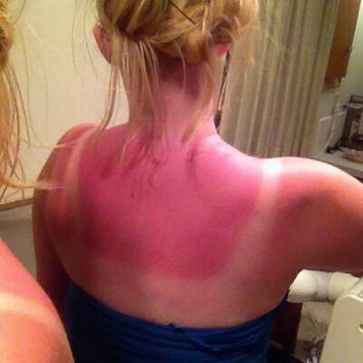 Die schlimmsten Sonnenbrände der Welt