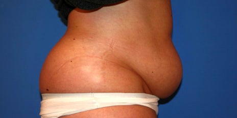 1 Vorher Bauchdeckenstraffung