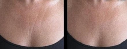 La Decollette: Anti-Falten BH für die Nacht