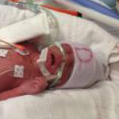 Die Vierlinge müssen medizinisch überwacht werden. 