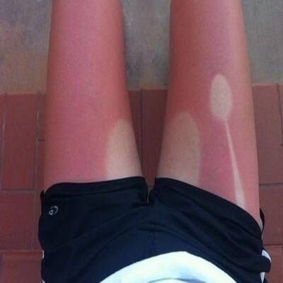 Die schlimmsten Sonnenbrände der Welt