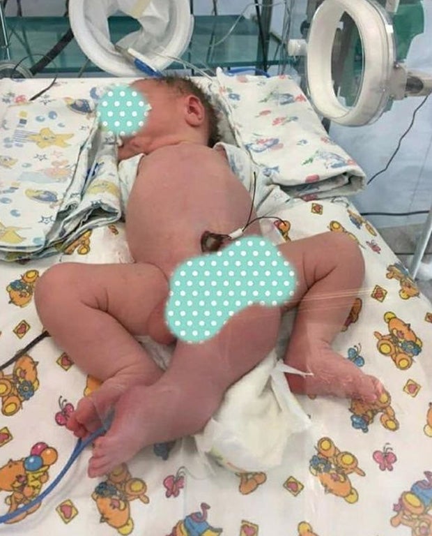 Baby mit 3 Beinen und 2 Penissen geboren