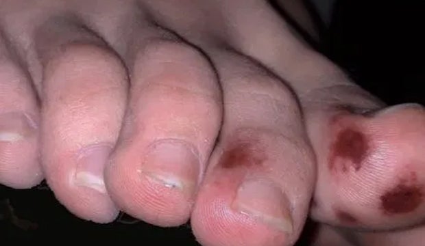 Blaue Flecken könnten auf Corona-Infektion hindeuten