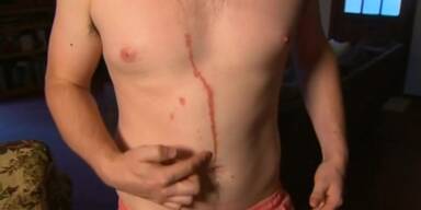 Spinne bohrt sich unter Haut