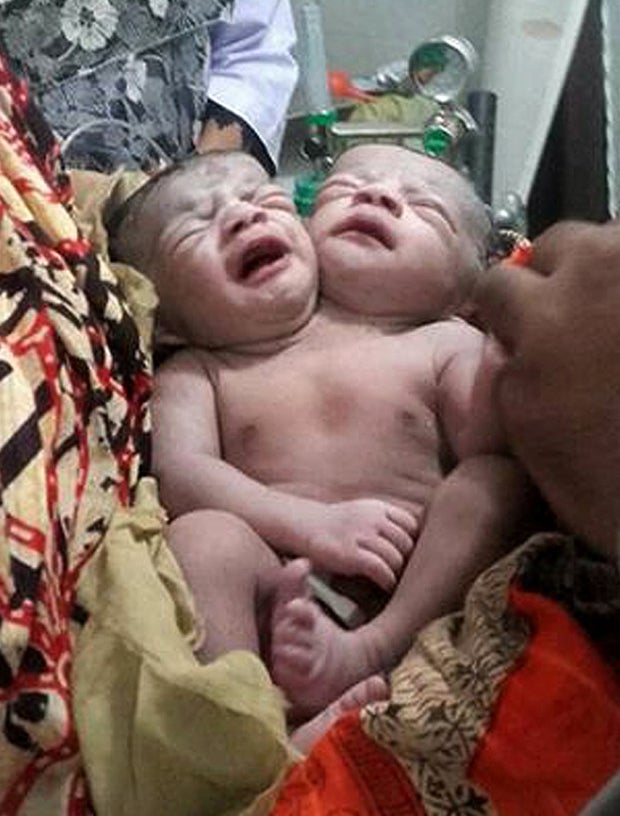 Mädchen mit zwei Köpfen geboren