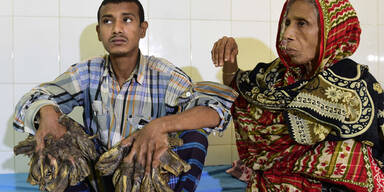 &Auml;rzte wollen "Baum-Mann" retten