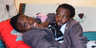 Bekanntes siamesisches Zwillingspaar gestorben