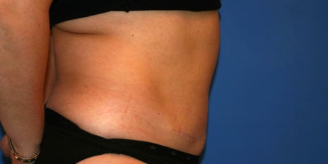 2 Nachher Bauchdeckenstraffung