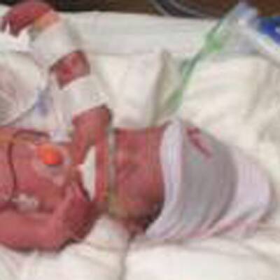 Die Vierlinge müssen medizinisch überwacht werden. 