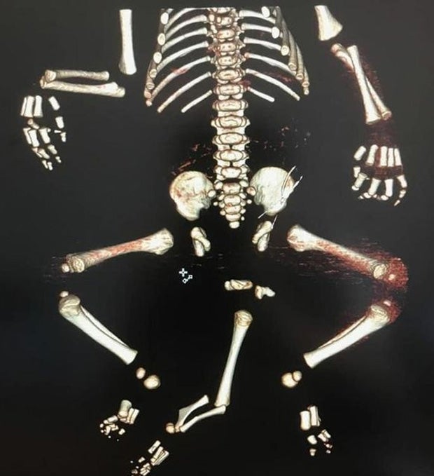 Baby mit 3 Beinen und 2 Penissen geboren