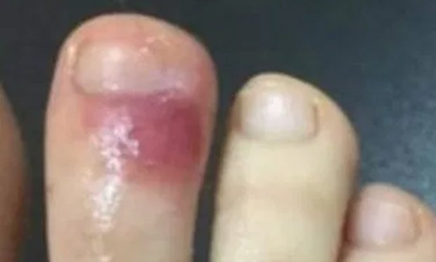 Blaue Flecken könnten auf Corona-Infektion hindeuten