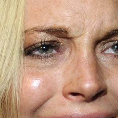 Lindsay Lohan - tiefe Falten mit 23!