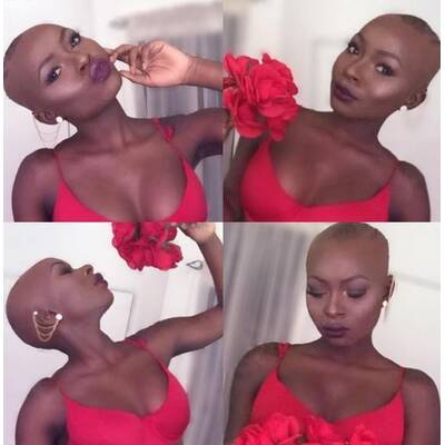 Brandopfer macht anderen Mut