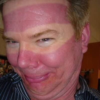 Die schlimmsten Sonnenbrände der Welt