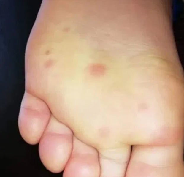 Blaue Flecken könnten auf Corona-Infektion hindeuten