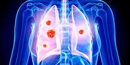 Wieder falsche Krebsdiagnose: Steirerin wurde gesunde Lunge entfernt