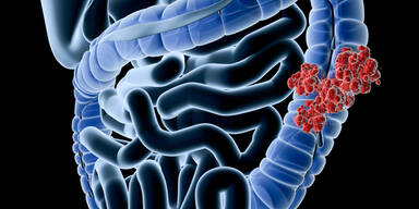 Darmkrebs