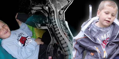 Querschnittsgelähmter Bub kann wieder gehen