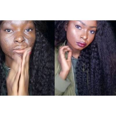 Brandopfer macht anderen Mut