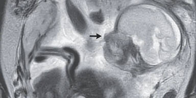 &Auml;rzte finden Baby im Darm