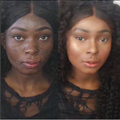 Brandopfer macht anderen Mut